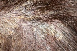 dermatitis seboreica